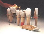 Modèle géant de prothèses dentaire,inscriptions anglaises
